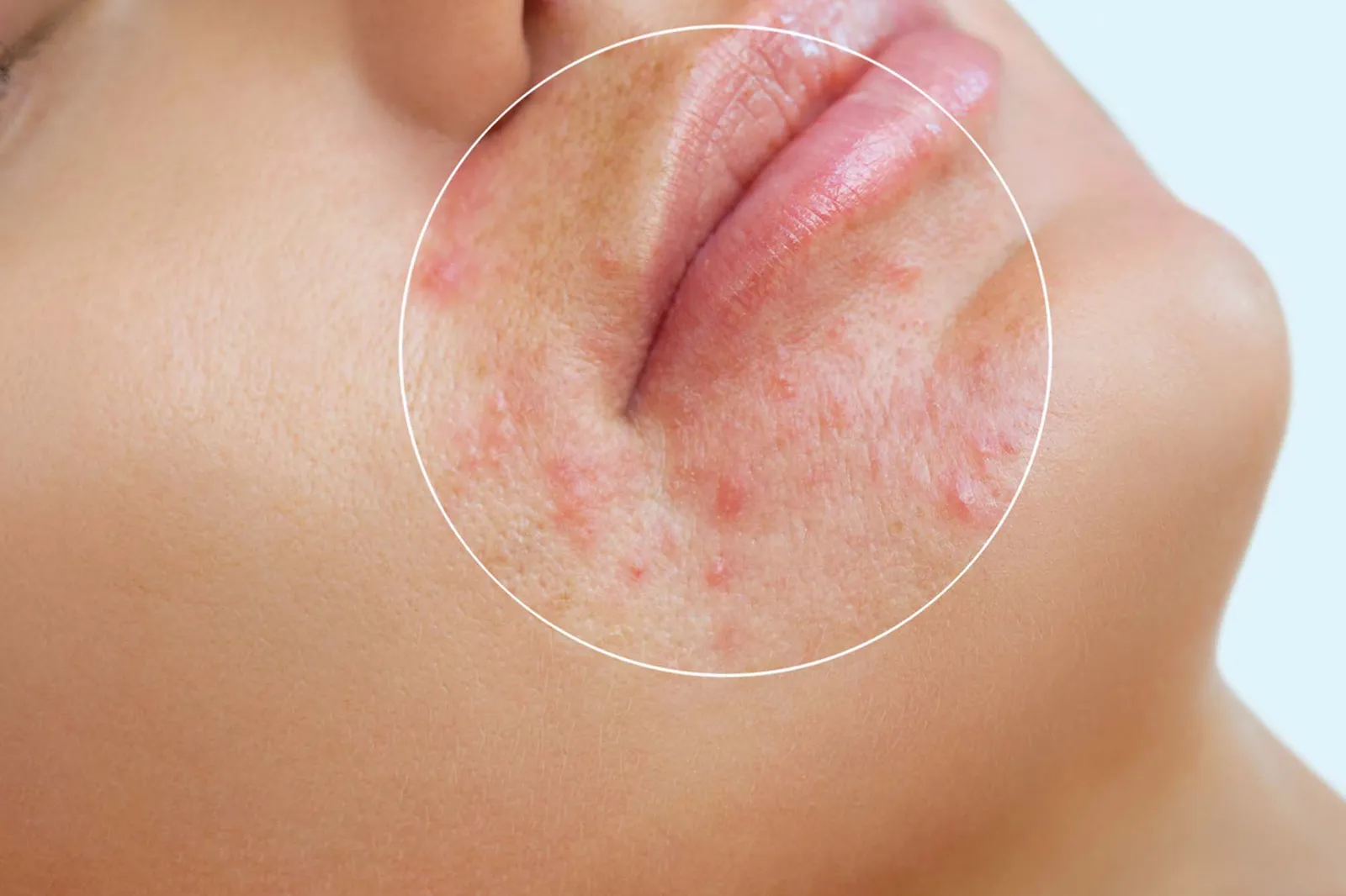 A young girl with a problem skin. Photo before and after treatment for acne. Treatment of problem skin cosmetology concept.