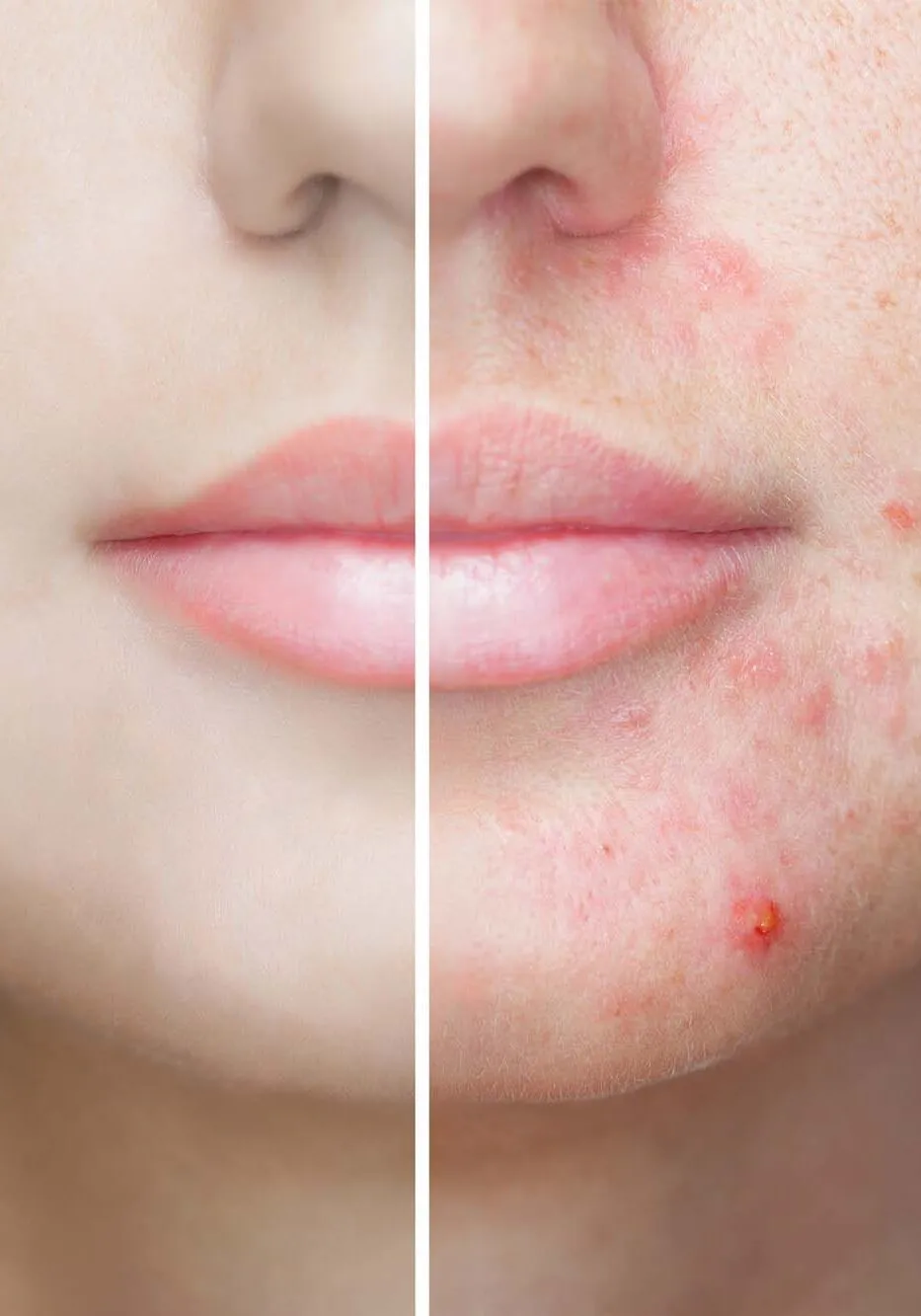 A young girl with a problem skin. Photo before and after treatment for acne.