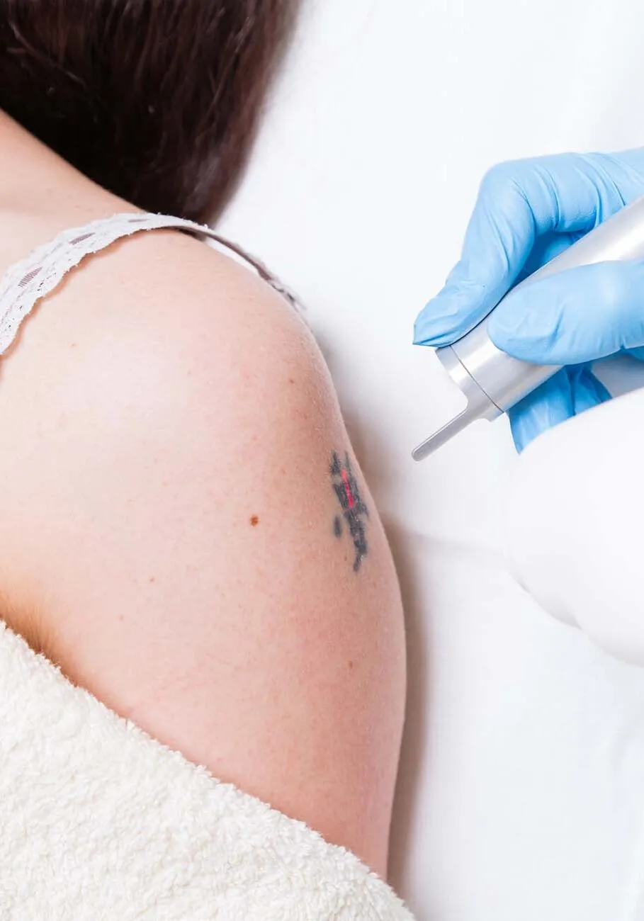 Removing tattoo on arm of a young woman by medical laser.