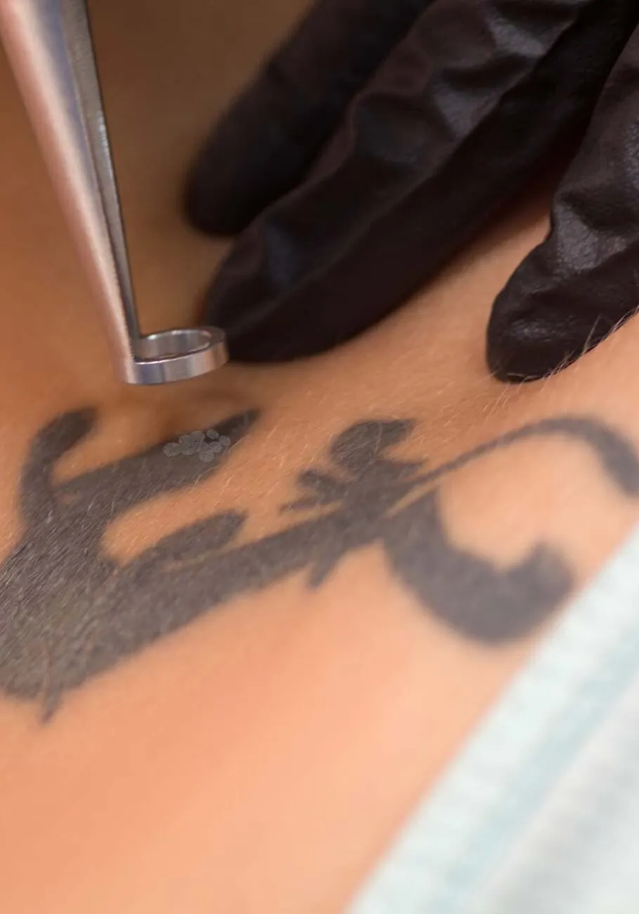 Laser tattoo removal procedure. Salon equipment