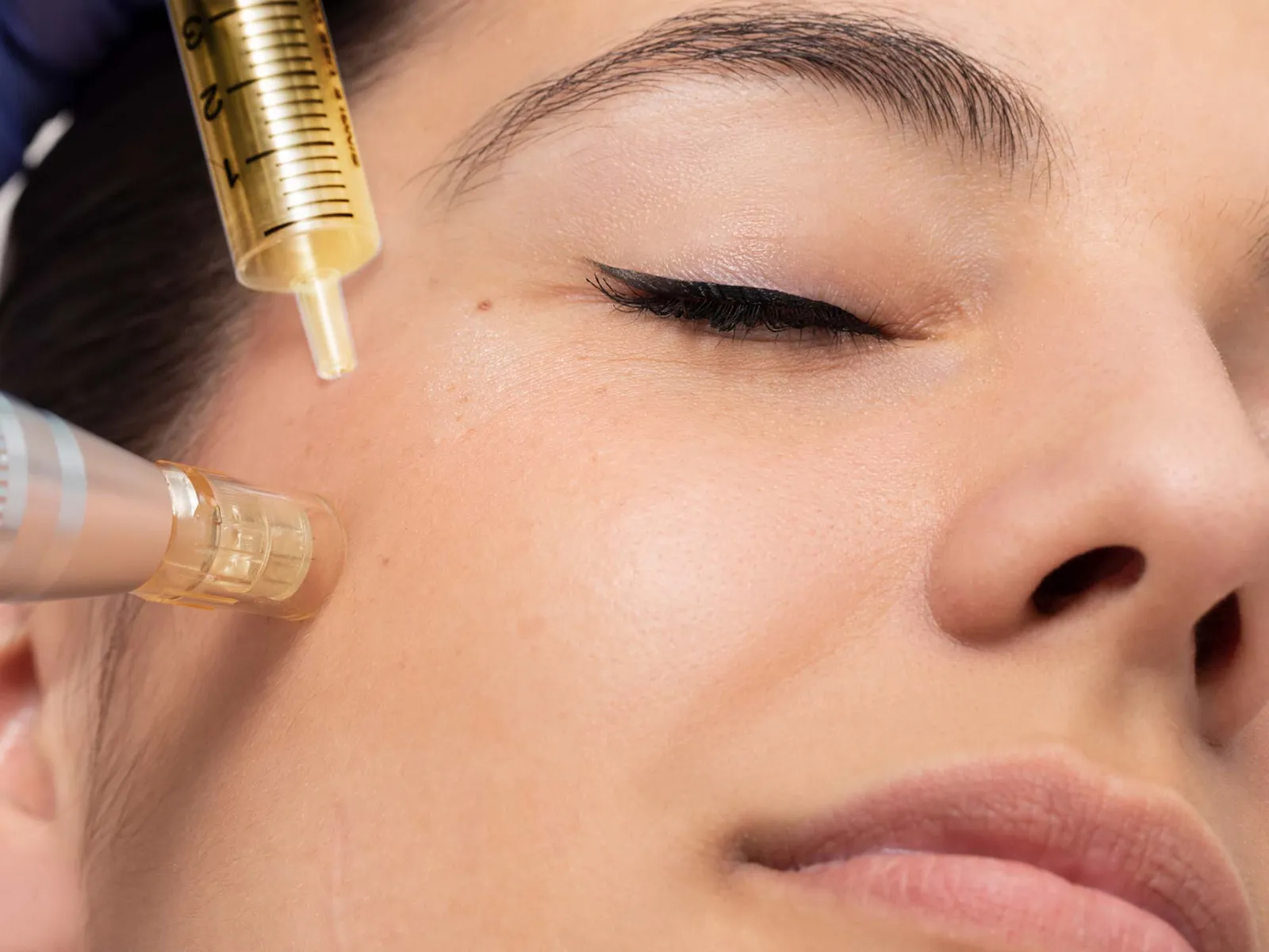 Face shot of woman having micro needle cosmetic treatment on face.Therapist reducing crow`s feet around eyes injecting hormones and proteins.