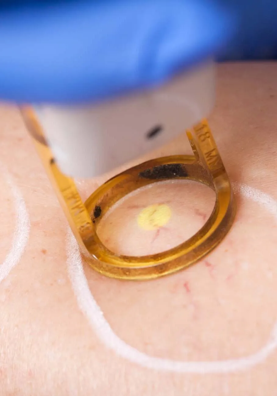 Removal of spider veins on the leg by laser treatment.